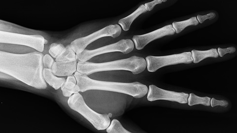 X-ray of a hand